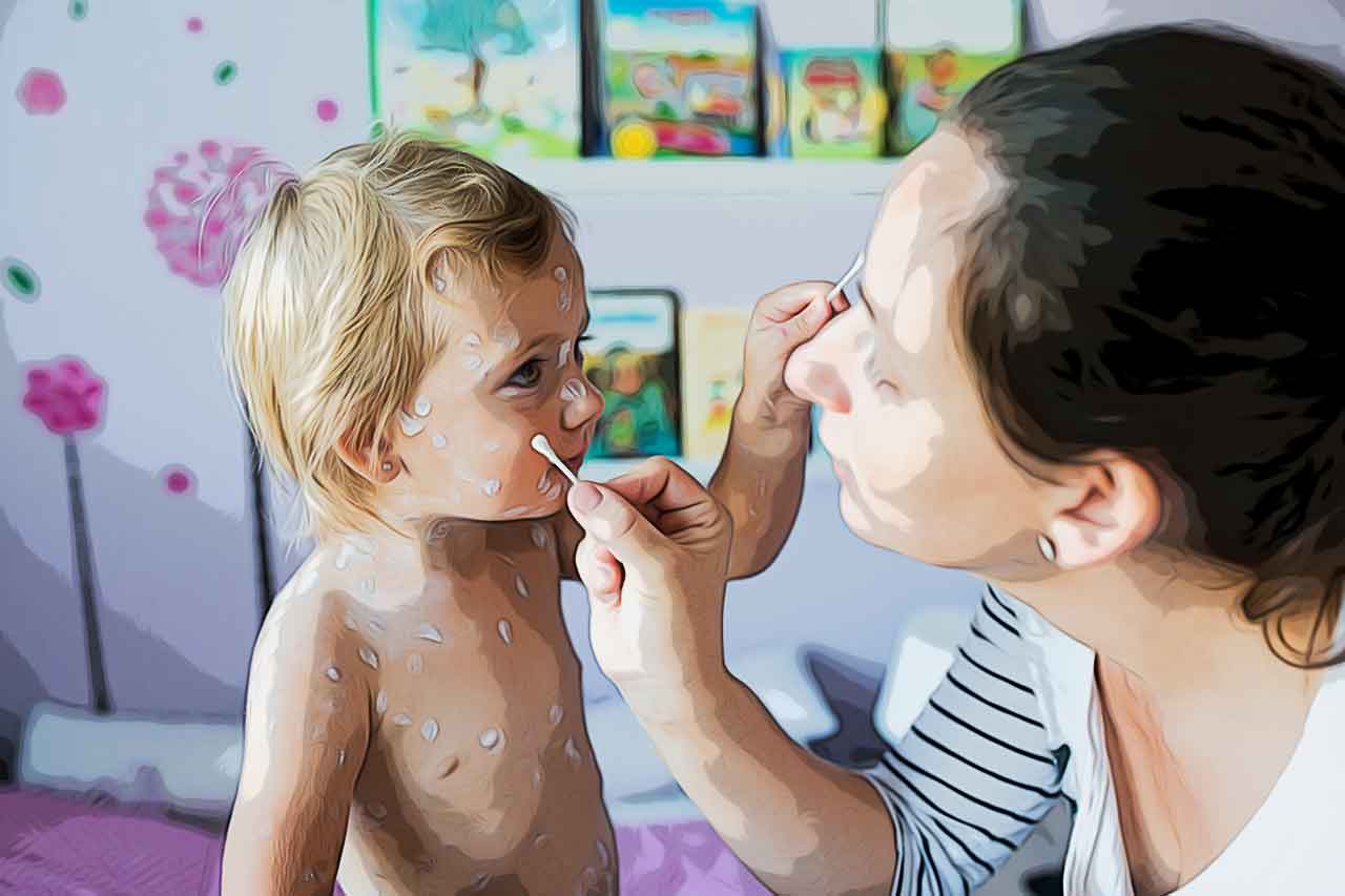 Catapora: Bolinhas Vermelhas e Muita Coceira nas Crianças_thumbnail