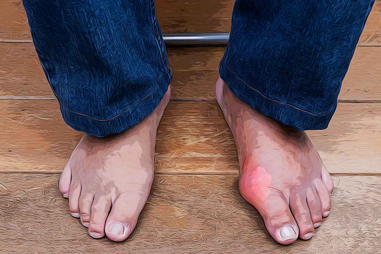 Gota: O que o ácido úrico tem a ver com essa Inflamação?_thumbnail